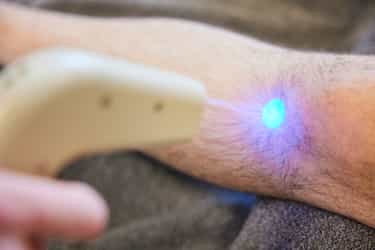Nahaufnahme der Kryolight-Sonde mit blauem Kaltstrahl auf dem Knie während der Anwendung