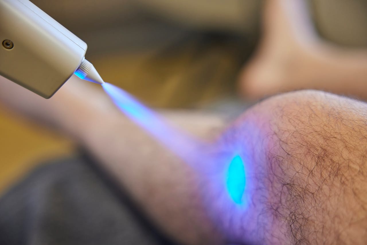 Kryotherapie als Teil Ihres Behandlungsplans